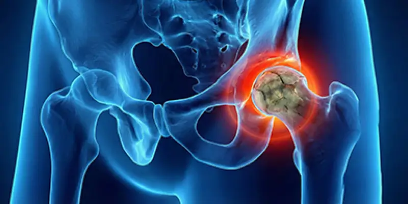 Avasküler Nekroz Tedavisi (Core Decompression)