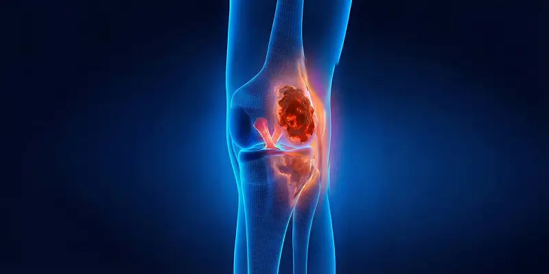 Kemik Tümörü Belirtileri: Gece Ağrısı, Şişlik ve Kırıklar