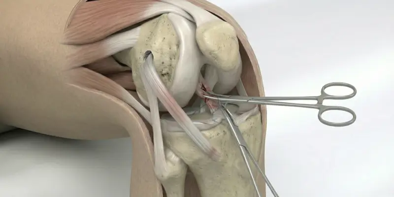 Ön Çapraz Bağ (ÖÇB) Rekonstrüksiyonu