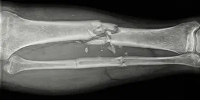 Parçalı Kırık Nedir?