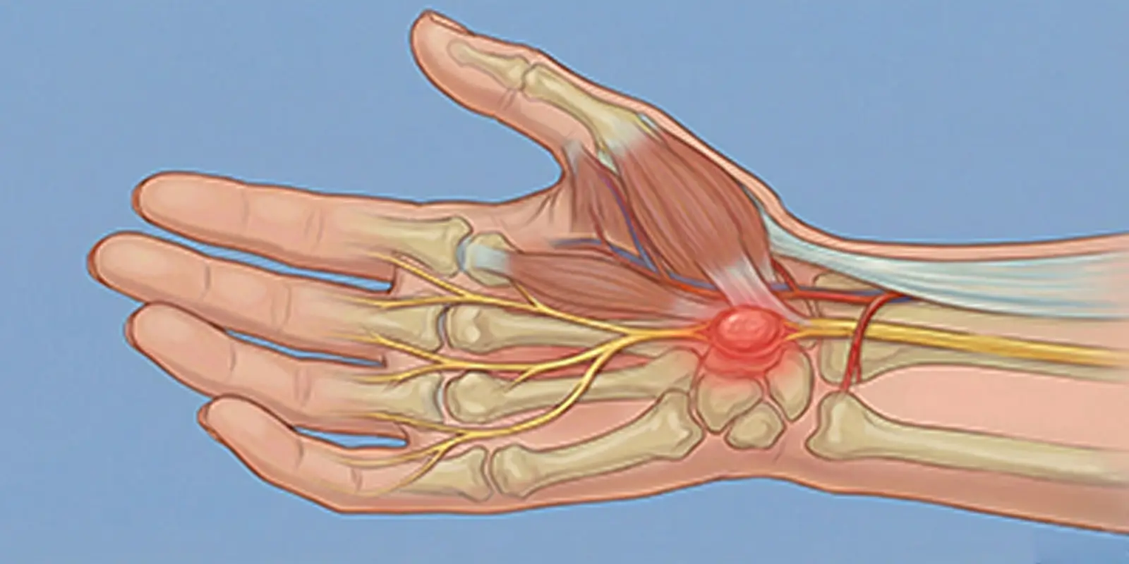 Schwannom (Sinir Kılıfı Tümörü) Nedir? Nedenleri, Belirtileri ve Tedavisi